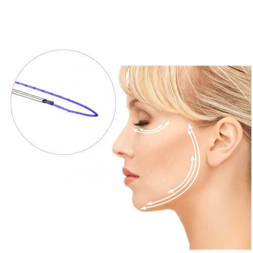 نخ لیفت دور چشم مدی لیفت Eye Thread